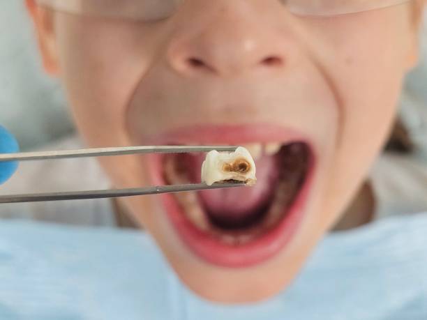 Best Emergency Broken Tooth Repair in Welch, WV